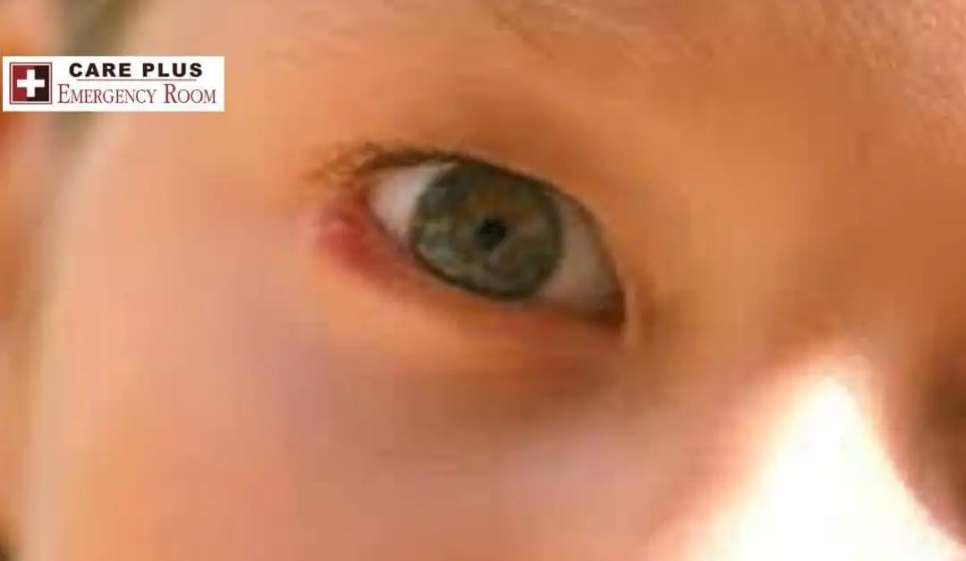 Pediatrics – Chalazia