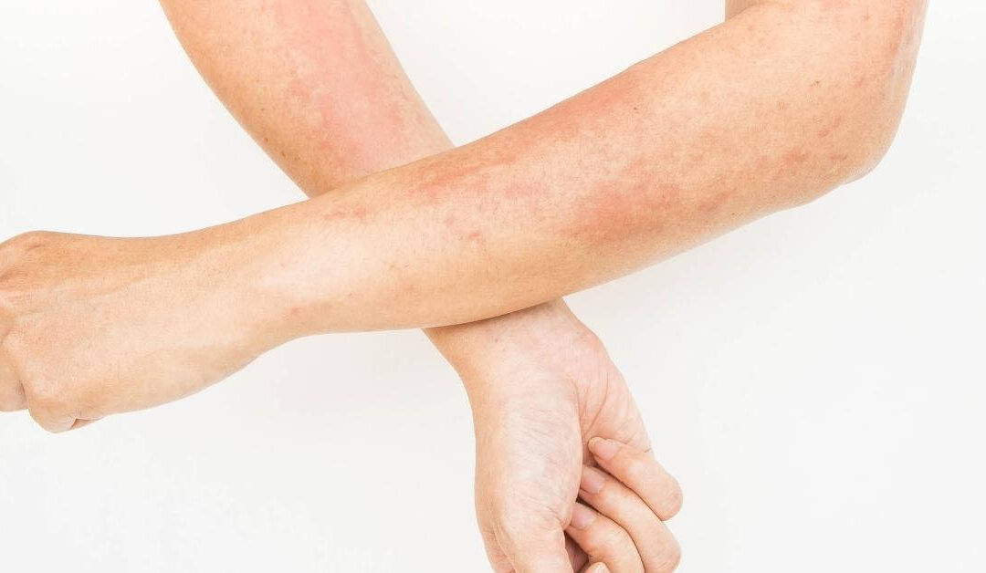 Skin Allergies – Contact Dermatitis