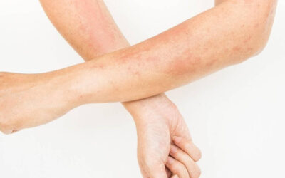 Skin Allergies – Contact Dermatitis