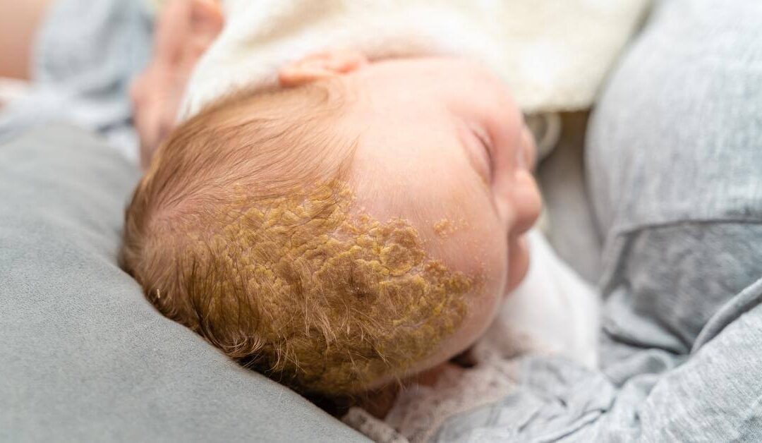 Pediatrics – Seborrhea, Cradle Cap