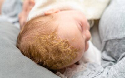 Pediatrics – Seborrhea, Cradle Cap
