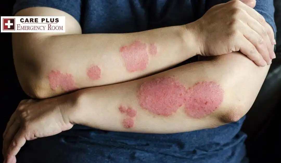 Eczema