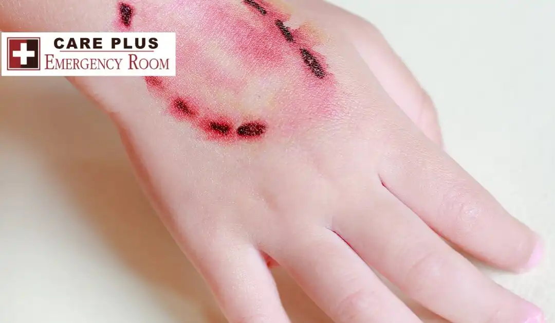 Bite Injuries – Human Bites