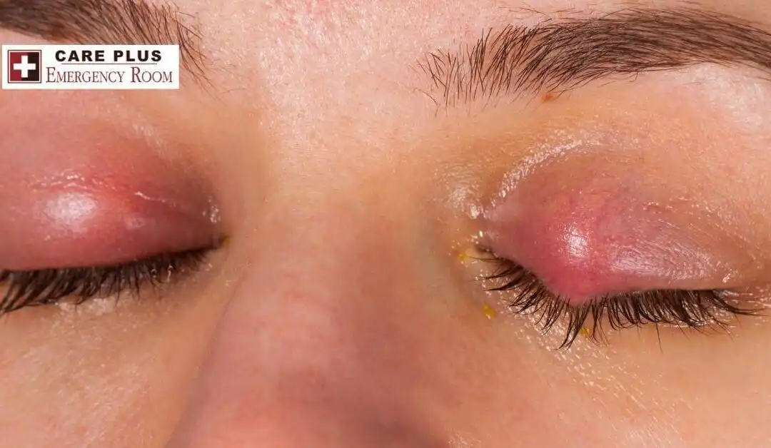 Conjunctivitis – Inner Eyelid Infection