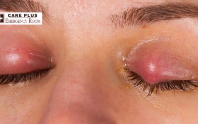 Conjunctivitis – Inner Eyelid Infection