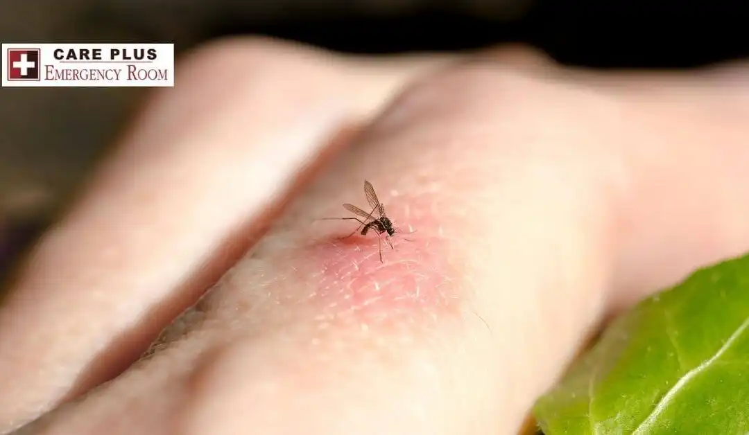 Insect Sting Allergy