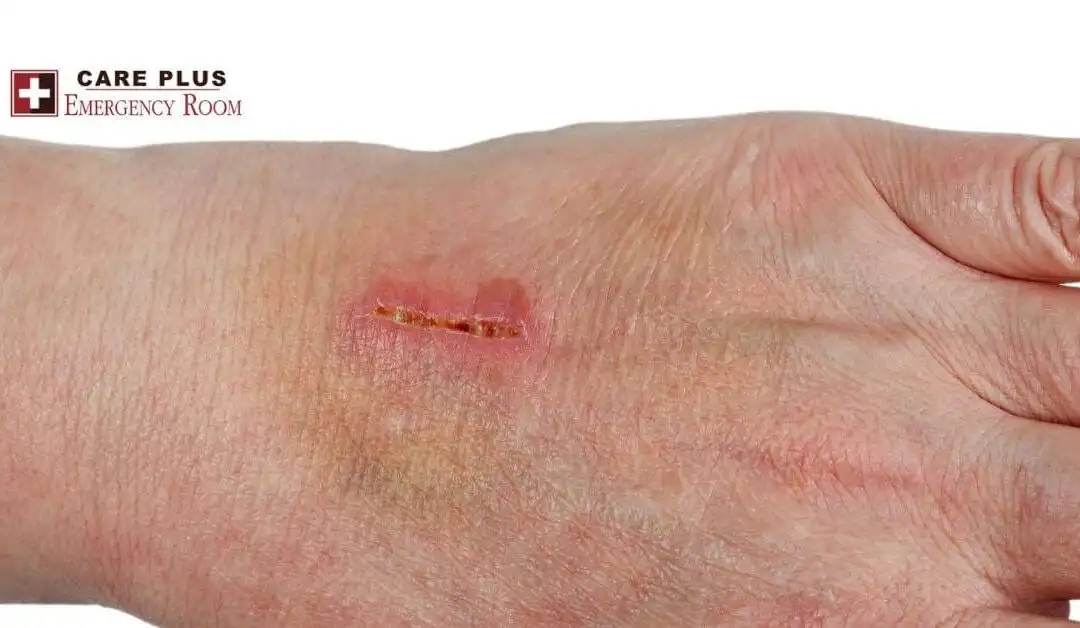 Lacerations (Cuts & Scratches)