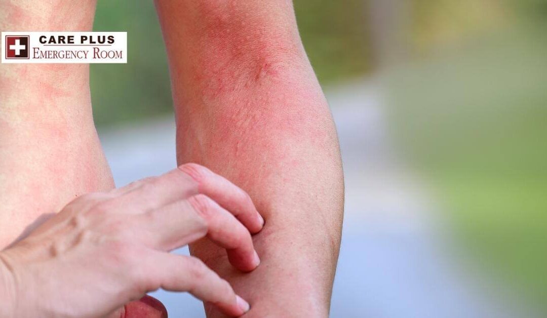 Medication Allergy