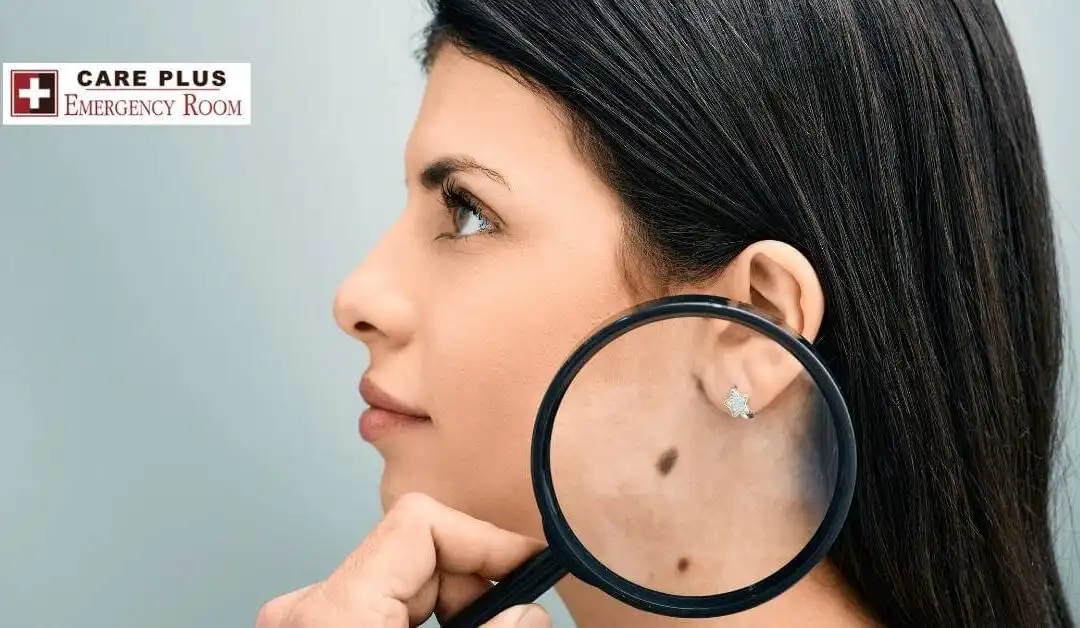 Pediatrics – Moles