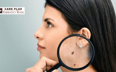 Pediatrics – Moles