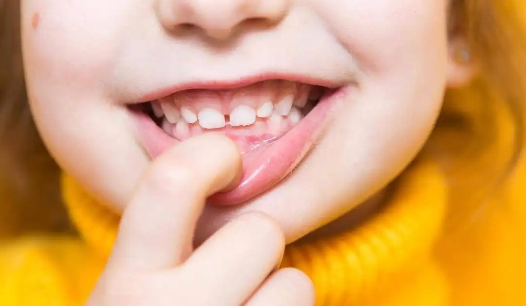 Pediatrics – Teething