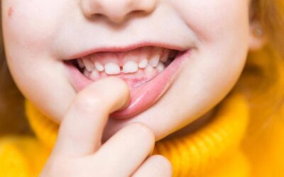 Pediatrics – Teething