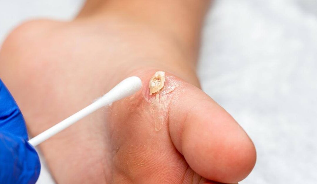 Pediatrics – Warts