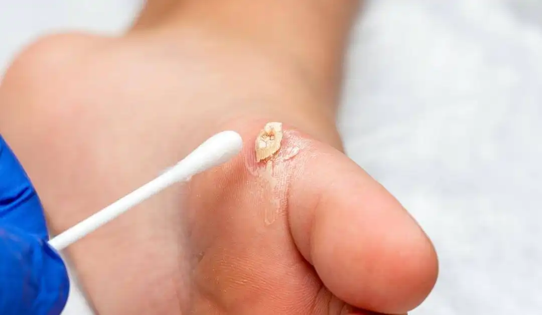 Pediatrics – Warts
