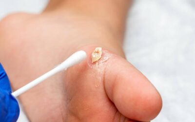 Pediatrics – Warts