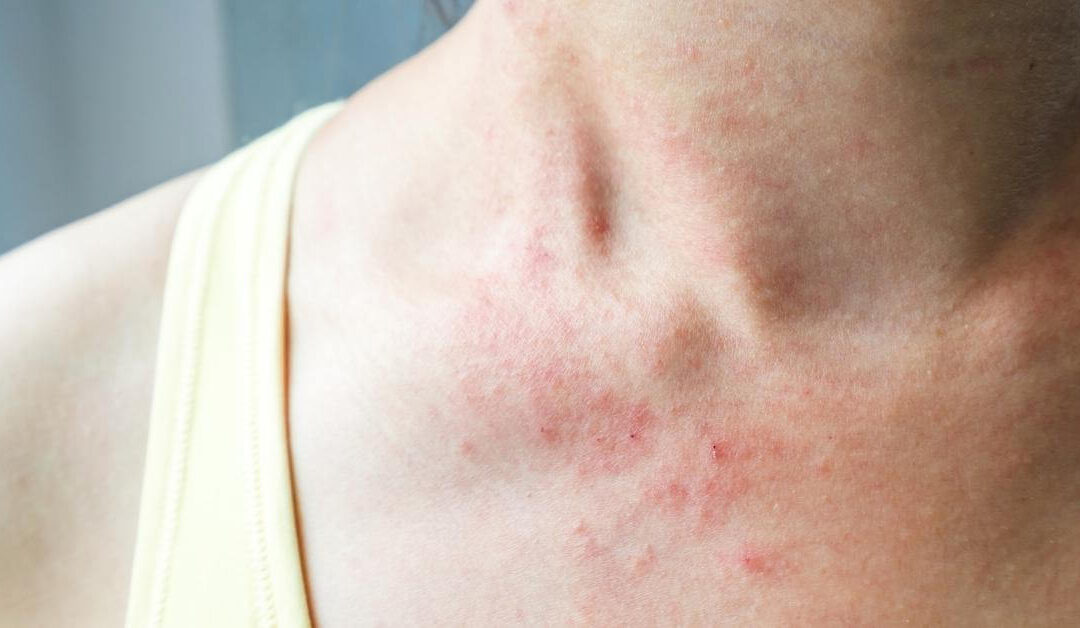 Rashes