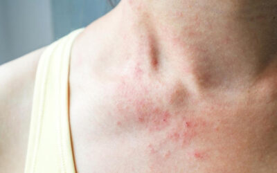 Rashes