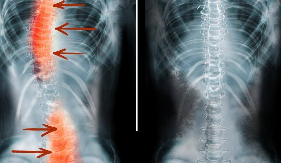 Scoliosis – Curvature of the Spine
