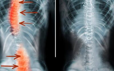 Scoliosis – Curvature of the Spine
