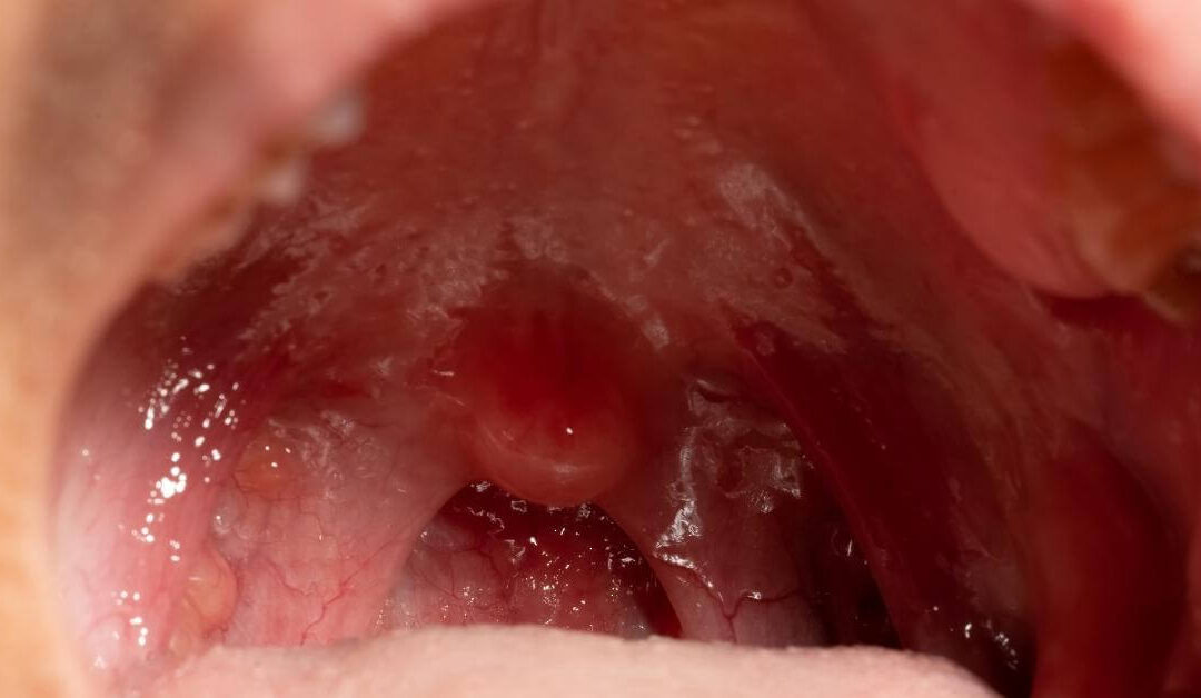 Tonsillitis