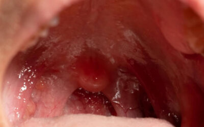 Tonsillitis