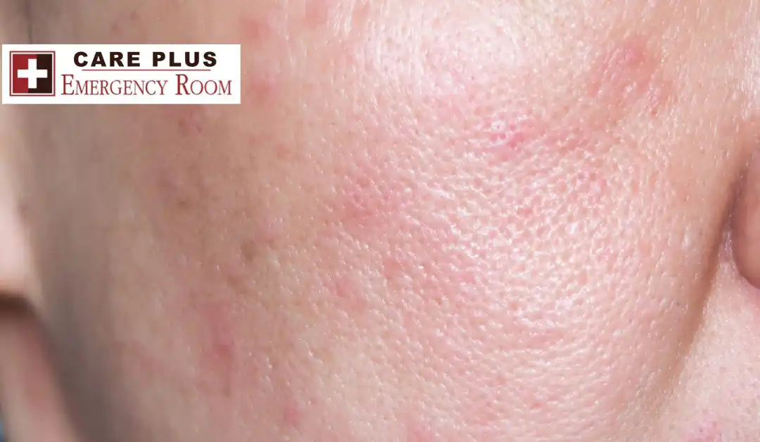 Anaphylaxis & Anaphylactic Shock